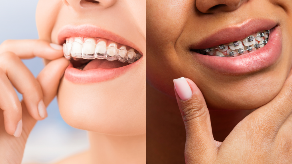 brackets metalicos o esteticos