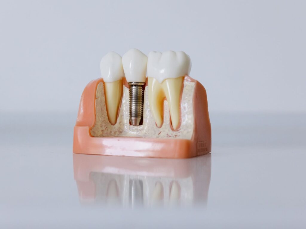 same-day dental crowns in Marbella