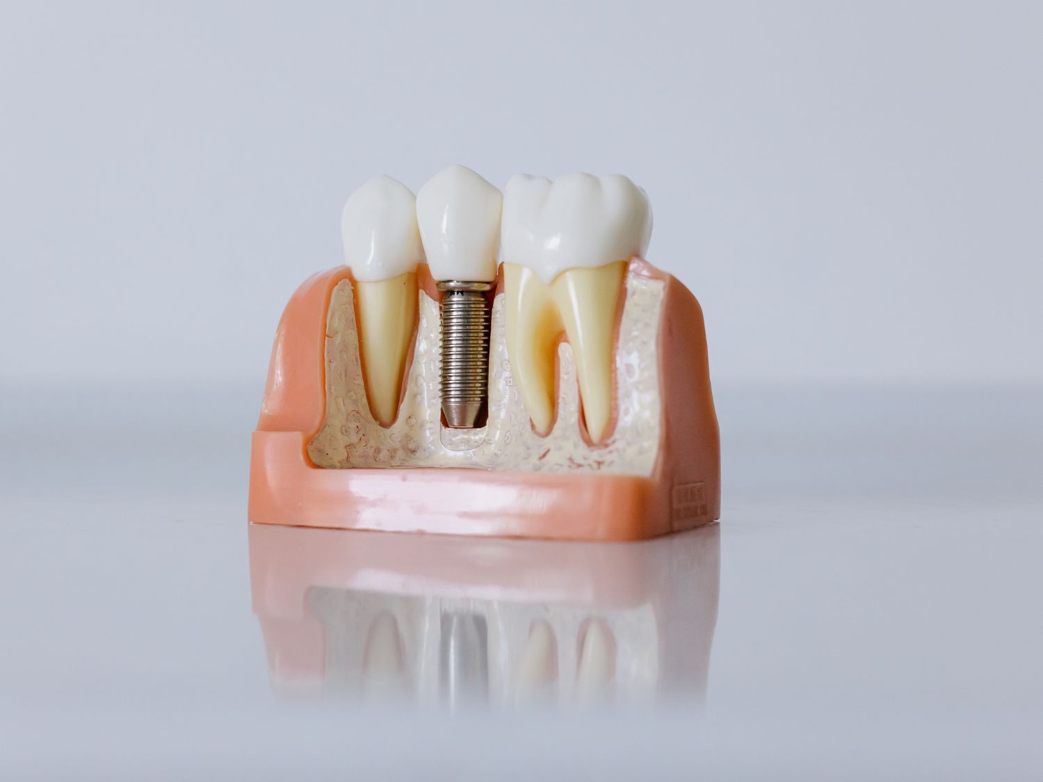 same-day dental crowns in Marbella